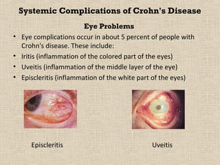 Systemic Complications of Crohn's Disease
                          Eye Problems
•   Eye complications occur in about 5 percent of people with
    Crohn's disease. These include:
•   Iritis (inflammation of the colored part of the eyes)
•   Uveitis (inflammation of the middle layer of the eye)
•   Episcleritis (inflammation of the white part of the eyes)




       Episcleritis                            Uveitis
 