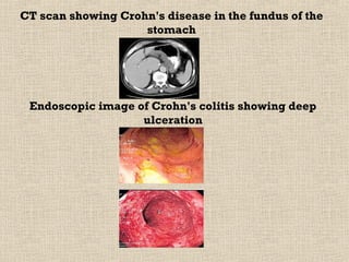 CT scan showing Crohn's disease in the fundus of the
                    stomach




 Endoscopic image of Crohn's colitis showing deep
                   ulceration
 