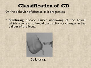 Classification of CD
On the behavior of disease as it progresses:

• Stricturing disease causes narrowing of the bowel
  which may lead to bowel obstruction or changes in the
  caliber of the feces.




                  Stricturing
 