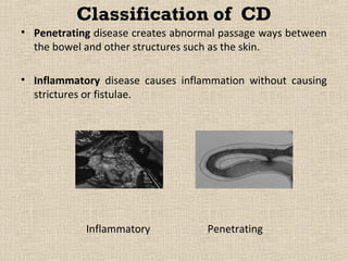 Classification of CD
• Penetrating disease creates abnormal passage ways between
  the bowel and other structures such as the skin.

• Inflammatory disease causes inflammation without causing
  strictures or fistulae.




            Inflammatory            Penetrating
 