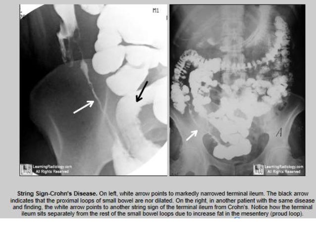Crohn s Disease Signs symptoms Morphology Crohn s Disease Signs symptoms Morphology