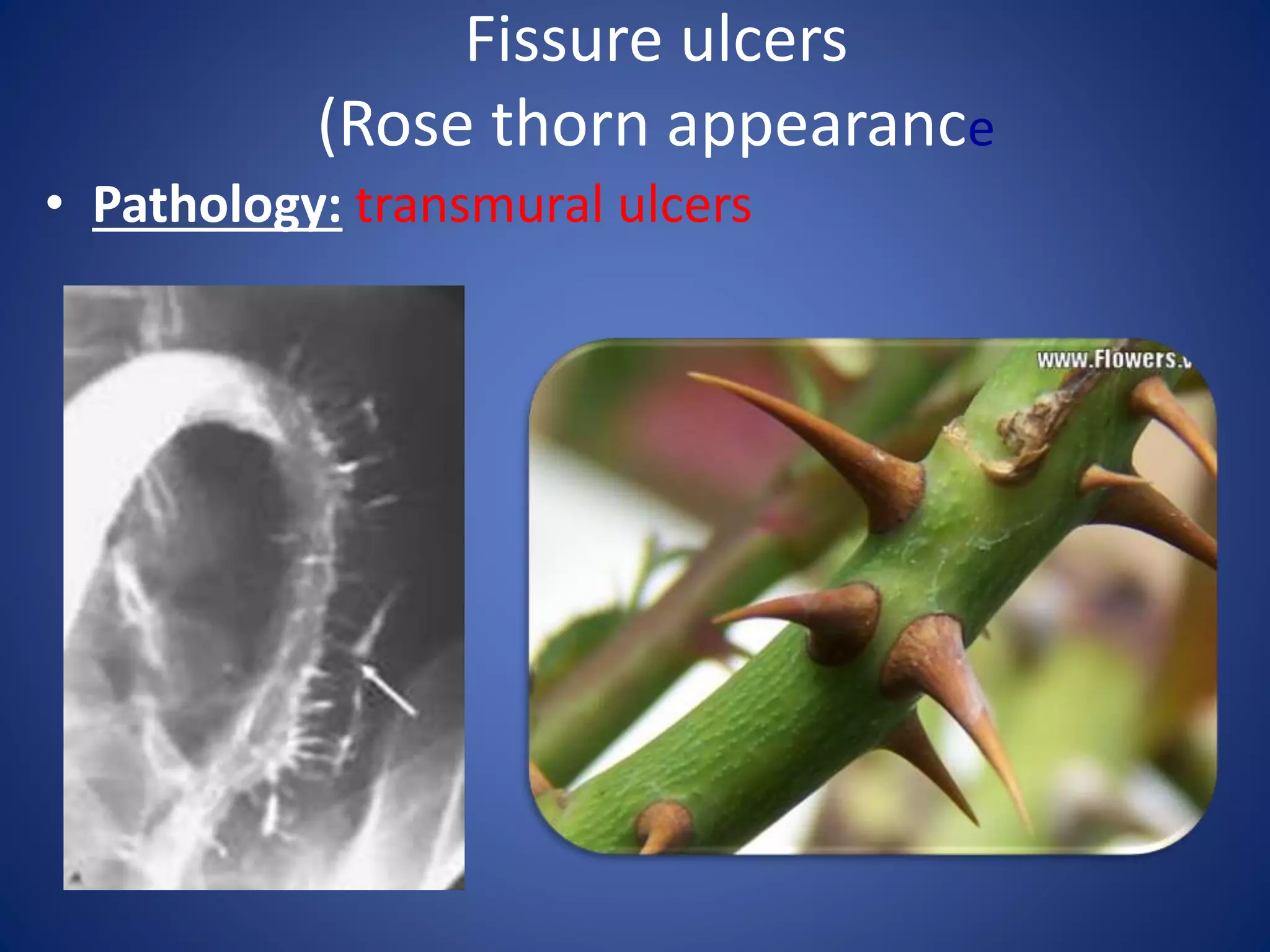 Crohns Disease PPTX crohns-disease-pptx