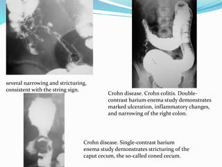 Crohn’s disease | PPTX