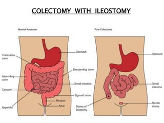 COLECTOMY WITH ILEOSTOMY
 