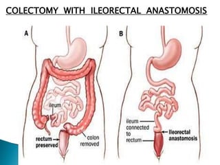 COLECTOMY WITH ILEORECTAL ANASTOMOSIS
 