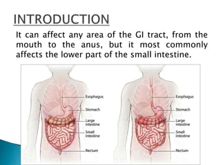 It can affect any area of the GI tract, from the
mouth to the anus, but it most commonly
affects the lower part of the small intestine.
 
