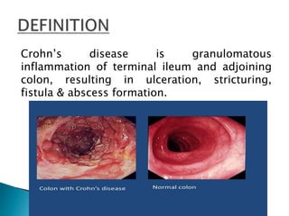 Crohn’s disease is granulomatous
inflammation of terminal ileum and adjoining
colon, resulting in ulceration, stricturing,
fistula & abscess formation.
 