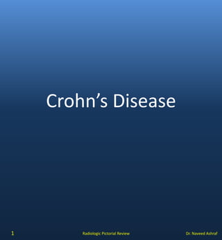 Dr. Naveed AshrafRadiologic Pictorial Review
Crohn’s Disease
1
 
