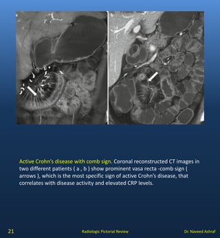 Crohns disease | PDF