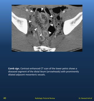 Crohns disease | PDF