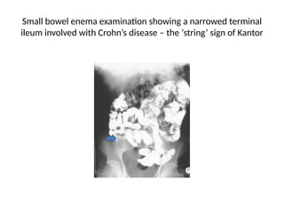 Crohn's disease inflammatory bowel disease.pptx