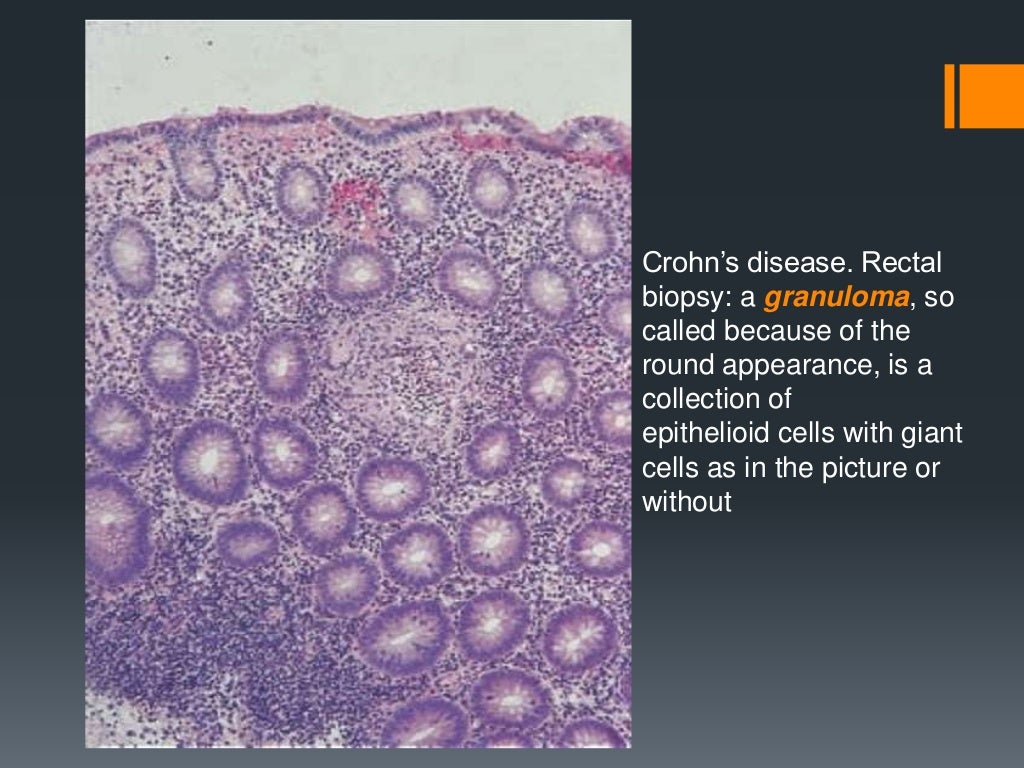 Crohn’s disease histopathology