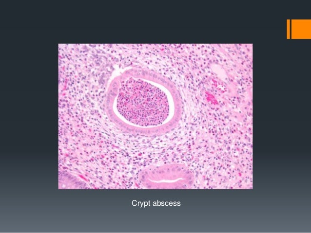 Crohns disease histopathology images — 1