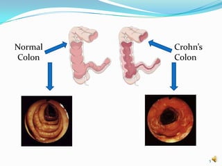 Normal   Crohn’s
Colon    Colon




                   5
 