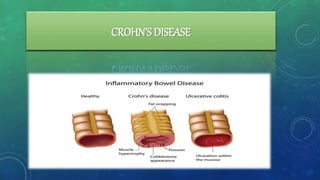 CROHN’SDISEASE
 