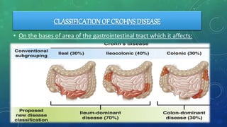 CLASSIFICATION OF CROHNS DISEASE
• On the bases of area of the gastrointestinal tract which it affects:
 
