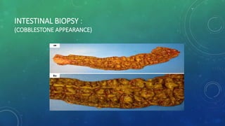 INTESTINAL BIOPSY :
(COBBLESTONE APPEARANCE)
 