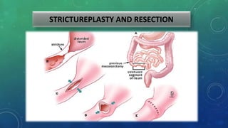 STRICTUREPLASTY AND RESECTION
 