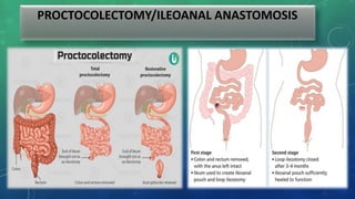 PROCTOCOLECTOMY/ILEOANAL ANASTOMOSIS
 