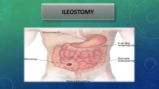 ILEOSTOMY
 