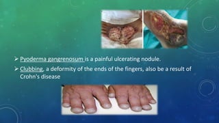  Pyoderma gangrenosum is a painful ulcerating nodule.
 Clubbing, a deformity of the ends of the fingers, also be a result of
Crohn's disease
 