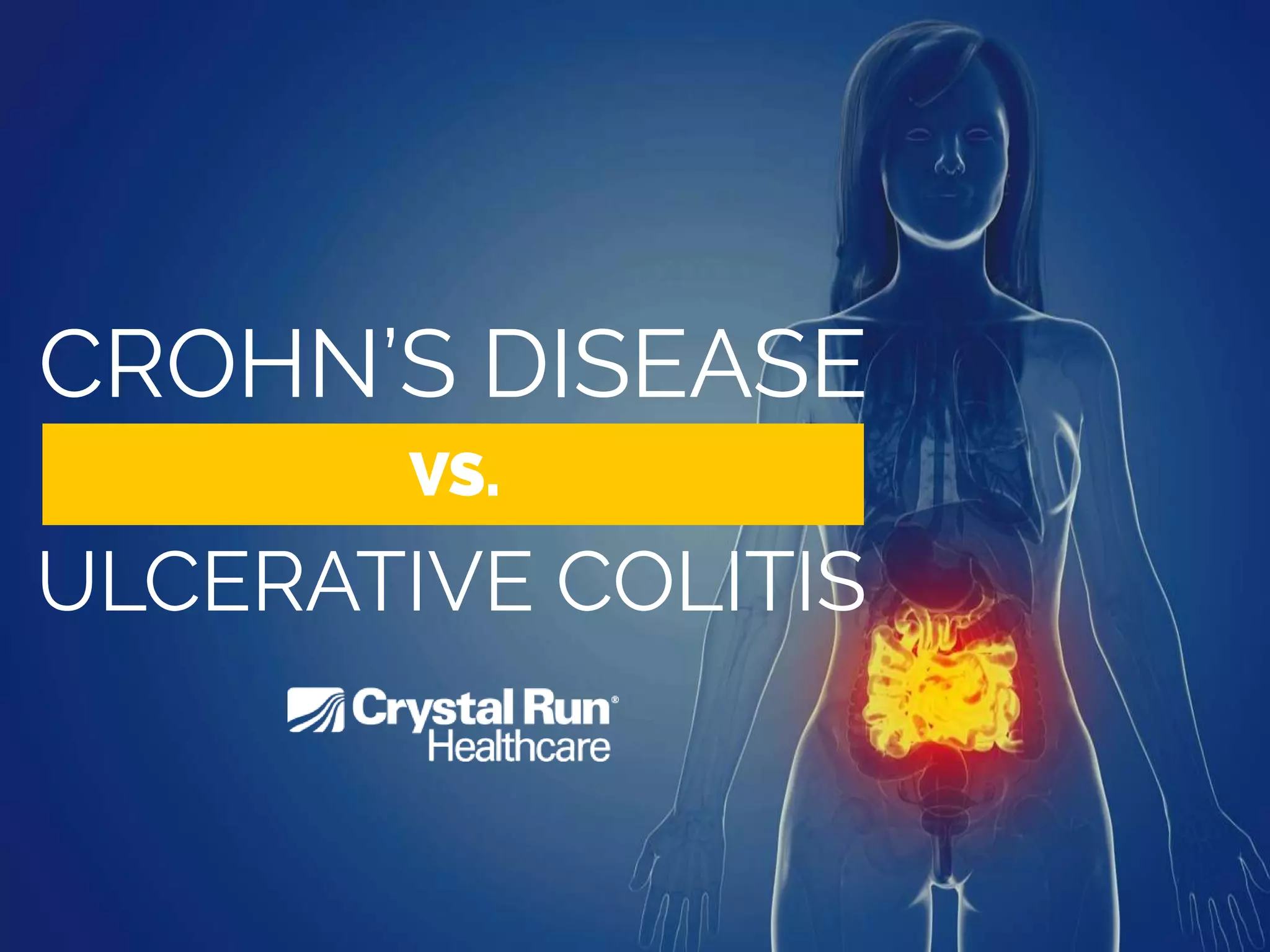 Crohn's Disease vs. Ulcerative Colitis | PDF