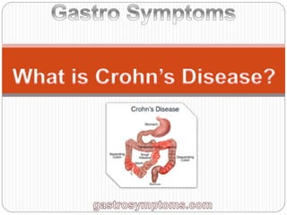 What is Crohns Disease 