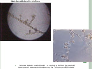  Fonsecaea pedrosoi. Hifas septadas. Las conidias se disponen en simpodias,
puede presentar ocasionalmente esporulación tipo Cladosporium y Phialophora.
 