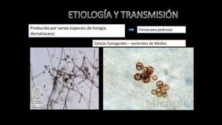 Producida por varias especies de hongos
dematiaceos:
Fonsecaea pedrosoi
Celulas fumagoides – esclerotes de Medlar.
 