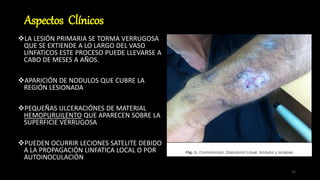 Aspectos Clínicos
LA LESIÓN PRIMARIA SE TORMA VERRUGOSA
QUE SE EXTIENDE A LO LARGO DEL VASO
LINFATICOS ESTE PROCESO PUEDE LLEVARSE A
CABO DE MESES A AÑOS.
APARICIÓN DE NODULOS QUE CUBRE LA
REGIÓN LESIONADA
PEQUEÑAS ULCERACIÓNES DE MATERIAL
HEMOPURUILENTO QUE APARECEN SOBRE LA
SUPERFICIE VERRUGOSA
PUEDEN OCURRIR LECIONES SATELITE DEBIDO
A LA PROPAGACIÓN LINFATICA LOCAL O POR
AUTOINOCULACIÓN
15
 