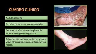 Nódulo pequeño
Se cubre de escamas y verrugosidades
Después de años se forman placas de
aspecto verrugoso o vegetante.
Cubren el pie, la mano, la pierna, y raras
veces otras regiones como el tronco y las
nalgas.
 