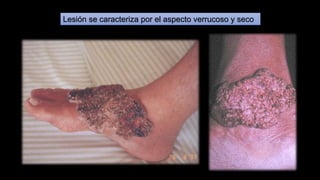 Lesión se caracteriza por el aspecto verrucoso y seco
 