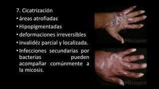 7. Cicatrización
•áreas atrofiadas
•Hipopigmentadas
•deformaciones irreversibles
•invalidéz parcial y localizada.
•Infecciones secundarias por
bacterias pueden
acompañar comúnmente a
la micosis.
26
 