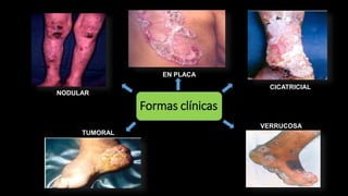 Formas clínicas
NODULAR
EN PLACA
CICATRICIAL
TUMORAL
VERRUCOSA
 