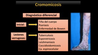 Diagnóstico diferencial
Inicial:
Lesiones
verrugosas:
Tiña del cuerpo
Psoriasis
Enfermedad de Bowen
Tuberculosis
Esporotricosis
Leishmaniasis
Coccidioidomicosis
Ca. espinocelular
 