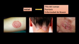 Inicial:
Tiña del cuerpo
Psoriasis
Enfermedad de Bowen
 