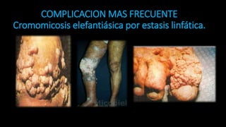 COMPLICACION MAS FRECUENTE
Cromomicosis elefantiásica por estasis linfática.
34
 
