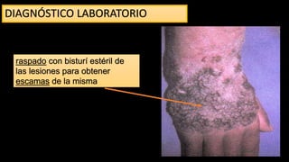 DIAGNÓSTICO LABORATORIO
• Toma de muestra
raspado con bisturí estéril de
las lesiones para obtener
escamas de la misma
 