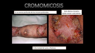 Es la menos profunda de las micosis profundas.
Solo afecta a la piel y
tejido celular subcutáneo.
Enfermedad de Lane y Pedroso
 