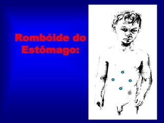 Rombóide do
Estômago:
 