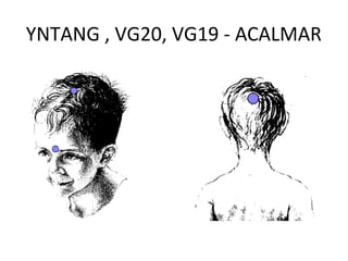 YNTANG , VG20, VG19 - ACALMAR
 