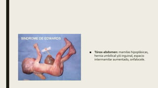 ■ Tórax-abdomen: mamilas hipoplásicas,
hernia umbilical y/ó inguinal, espacio
intermamilar aumentado, onfalocele.
 