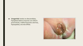 ■ Urogenital: testes no descendidos,
hipoplasia labios mayores con clítoris
prominente, malformaciones uterinas,
hipospadias, escroto bífido.
 