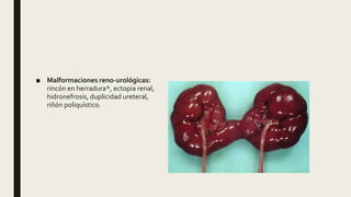 ■ Malformaciones reno-urológicas:
rincón en herradura*, ectopia renal,
hidronefrosis, duplicidad ureteral,
riñón poliquístico.
 
