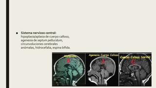 ■ Sistema nervioso central:
hipoplasia/aplasia de cuerpo calloso,
agenesia de septum pellucidum,
circunvoluciones cerebrales
anómalas, hidrocefalia, espina bífida.
 
