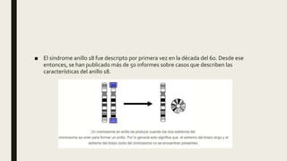 ■ El síndrome anillo 18 fue descripto por primera vez en la década del 60. Desde ese
entonces, se han publicado más de 50 informes sobre casos que describen las
características del anillo 18.
 