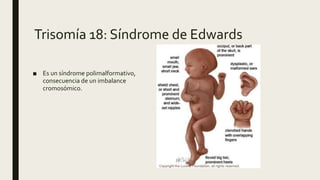 Trisomía 18: Síndrome de Edwards
■ Es un síndrome polimalformativo,
consecuencia de un imbalance
cromosómico.
 