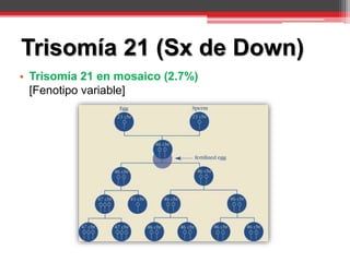 • Trisomía 21 en mosaico (2.7%)
[Fenotipo variable]
Trisomía 21 (Sx de Down)
 