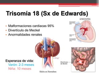 • Malformaciones cardiacas 95%
• Divertículo de Meckel
• Anormalidades renales
Esperanza de vida:
Varón: 2-3 meses
Niña: 10 meses
Trisomía 18 (Sx de Edwards)
 