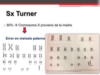 • 80%  Cromosoma X proviene de la madre
Error en meiosis paterna
Sx Turner
 